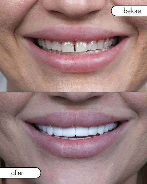 Close-up before and after image of a person's smile showing improved teeth alignment and whiteness.