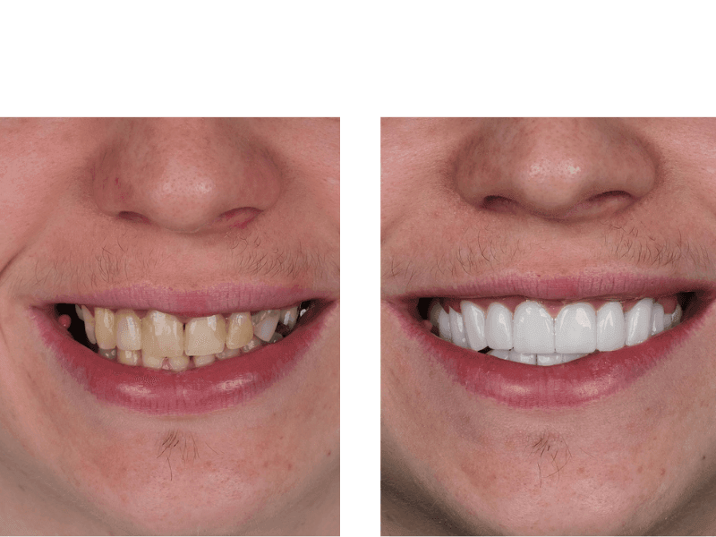 Before and after image of teeth whitening showing significant improvement in teeth color.